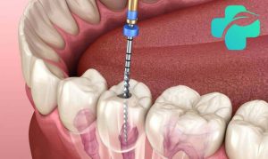 درد دندان بعد از عصب کشی