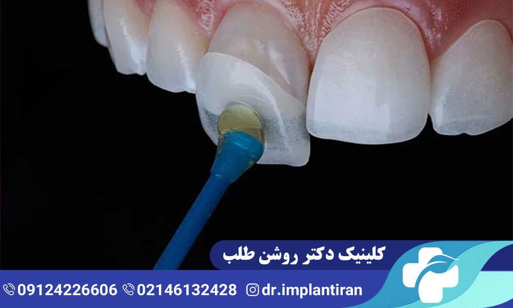 ونیر دندان چیست؟ مراحل، مزایا و معایب