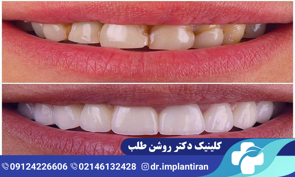 ونیر دندان چیست؟ مراحل، مزایا و معایب