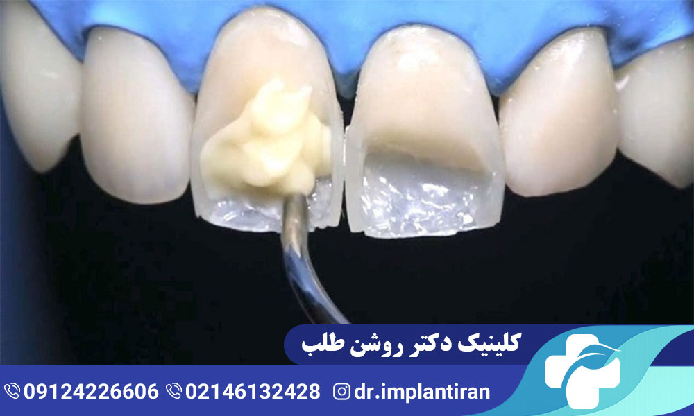 ونیر دندان چیست؟ مراحل، مزایا و معایب