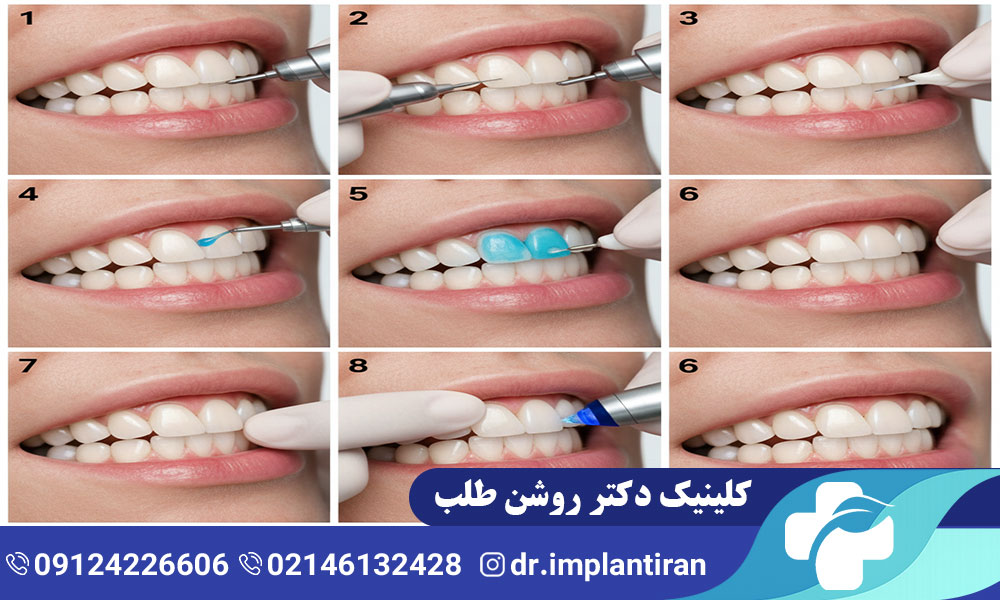ونیر دندان چیست؟ مراحل، مزایا و معایب