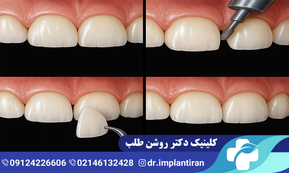 ونیر دندان چیست؟ مراحل، مزایا و معایب
