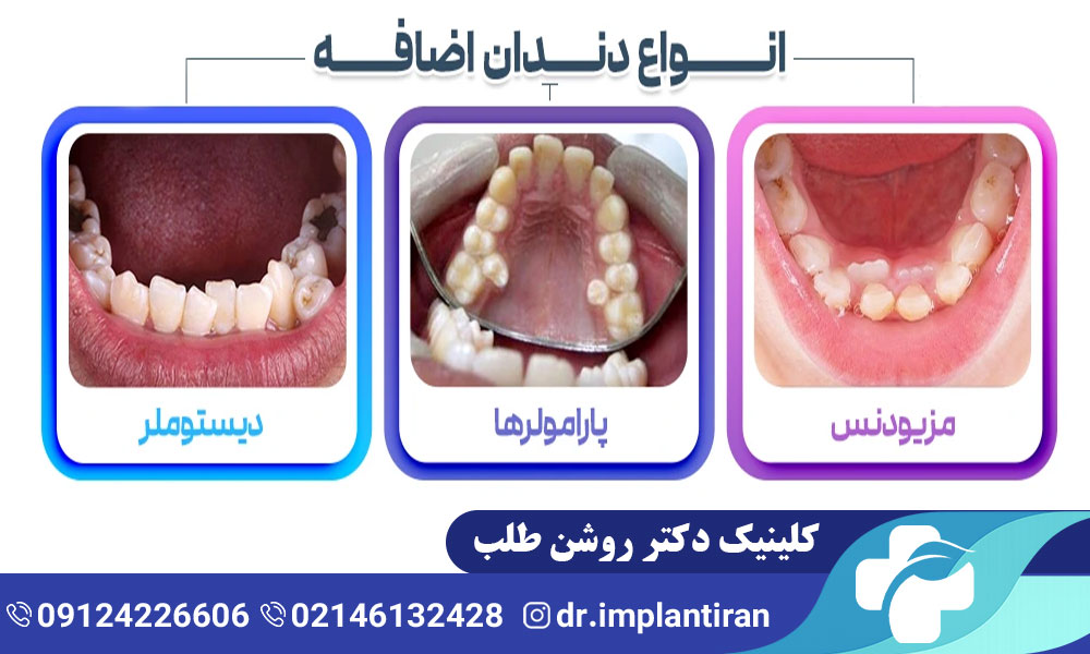 دندان اضافه چیست؟ علل و راه های درمان