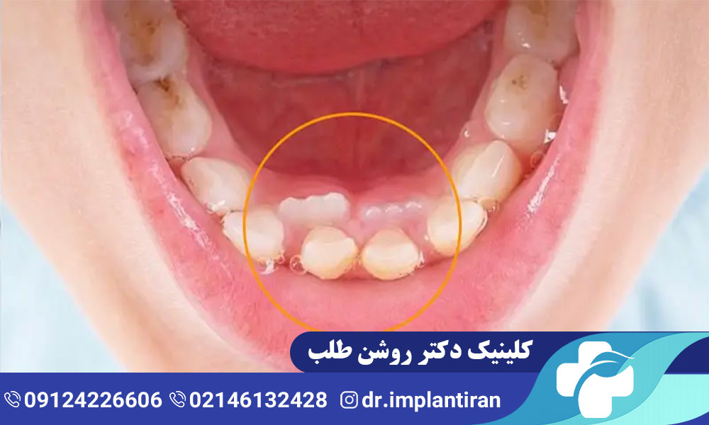 دندان اضافه چیست؟ علل و راه های درمان