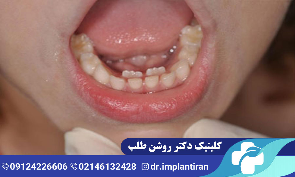 دندان اضافه چیست؟ علل و راه های درمان