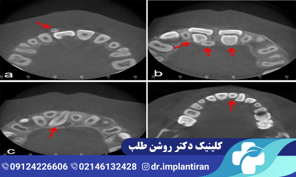 دندان اضافه چیست؟ علل و راه های درمان
