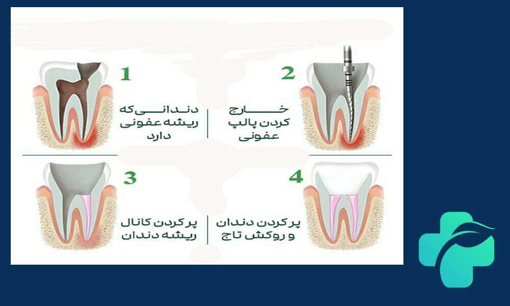 عصب کشی دندان