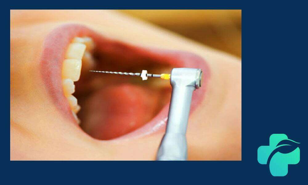 عصب کشی دندان