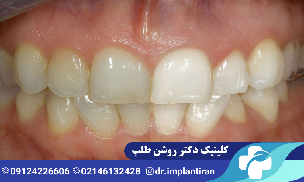 بلیچینگ دندان عصب کشی شده