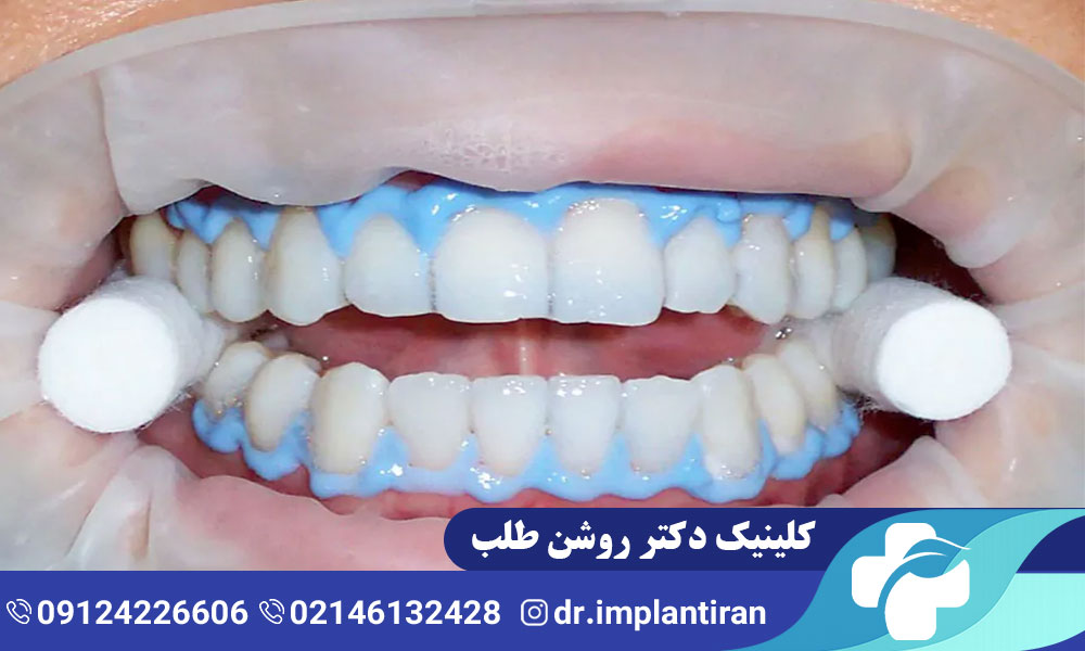 مراحل بلیچینگ دندان عصب کشی شده