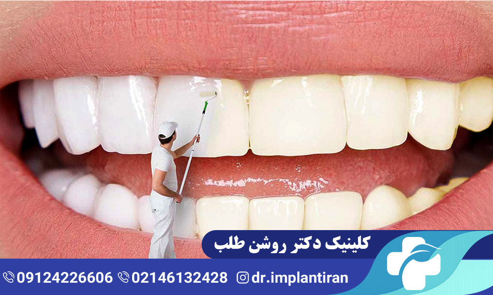 بلیچینگ دندان عصب کشی شده