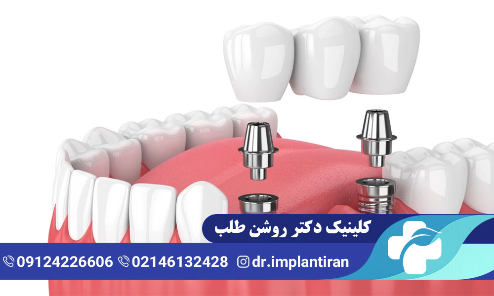 علائم پس زدن ایمپلنت دندان
