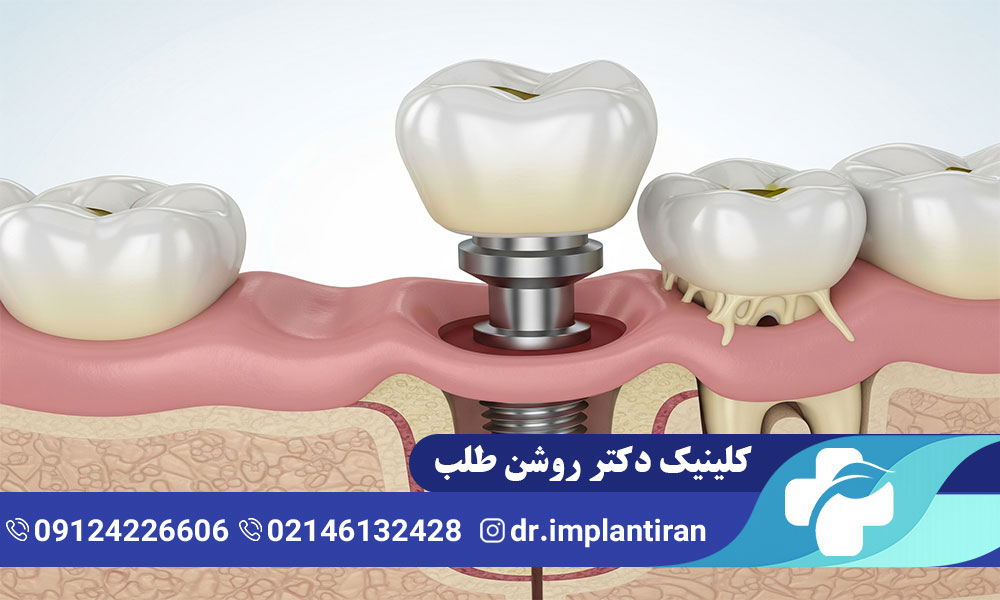 علائم پس زدن ایمپلنت دندان