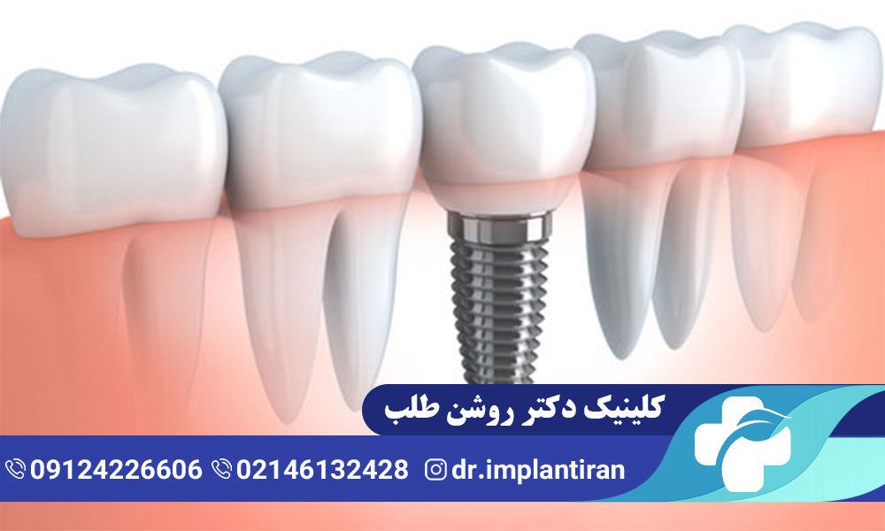 علائم پس زدن ایمپلنت دندان