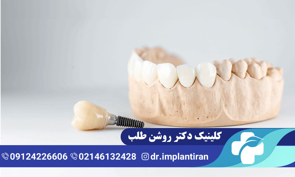 علائم پس زدن ایمپلنت دندان