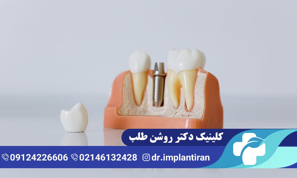 علائم پس زدن ایمپلنت دندان