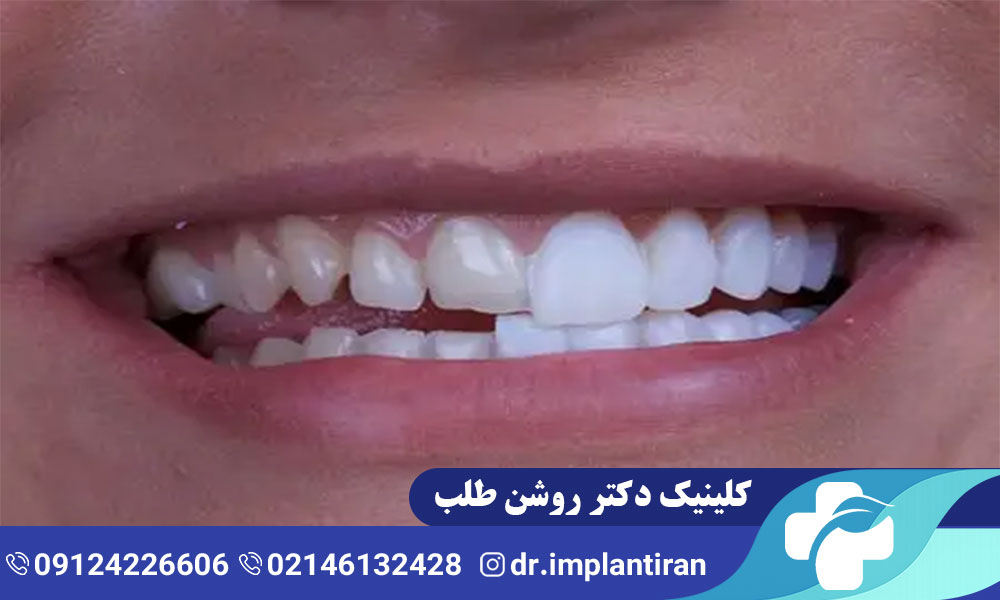 دلایل افتادن لمینت دندان