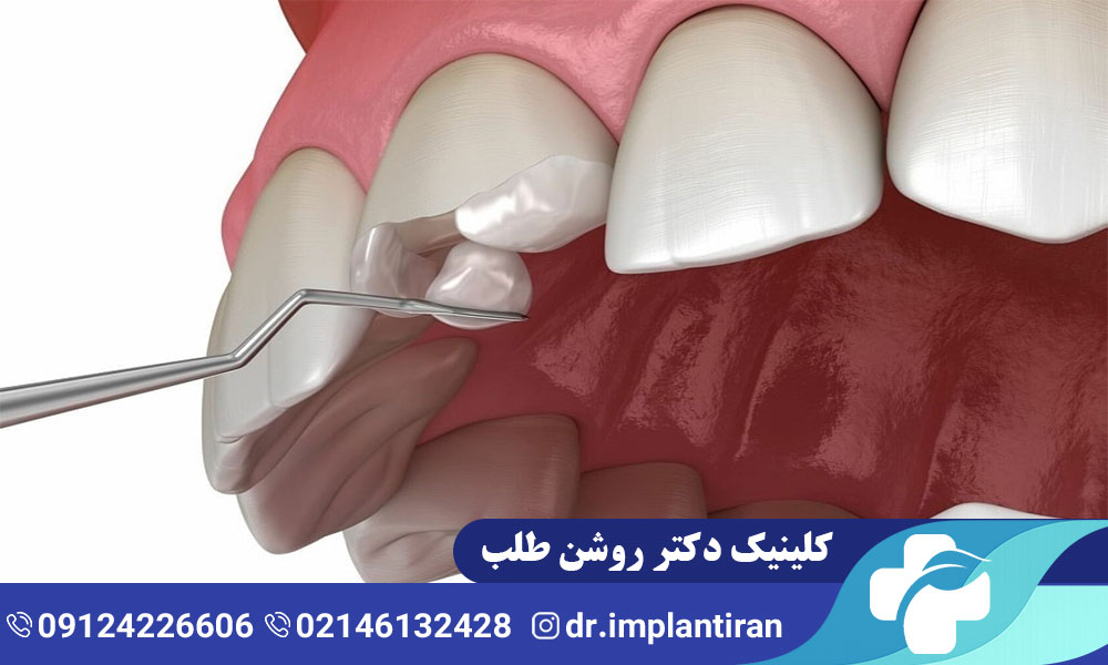 دلایل افتادن لمینت دندان