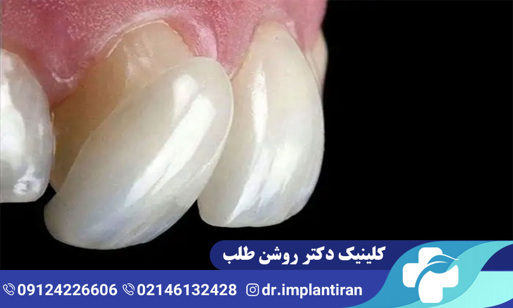 دلایل افتادن لمینت دندان