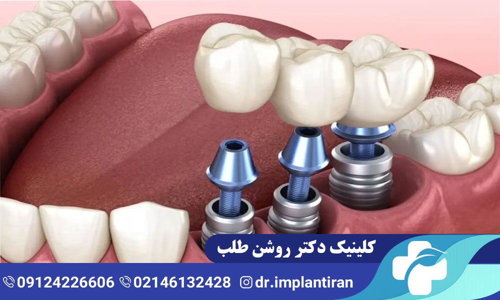 ایمپلنت متحرک