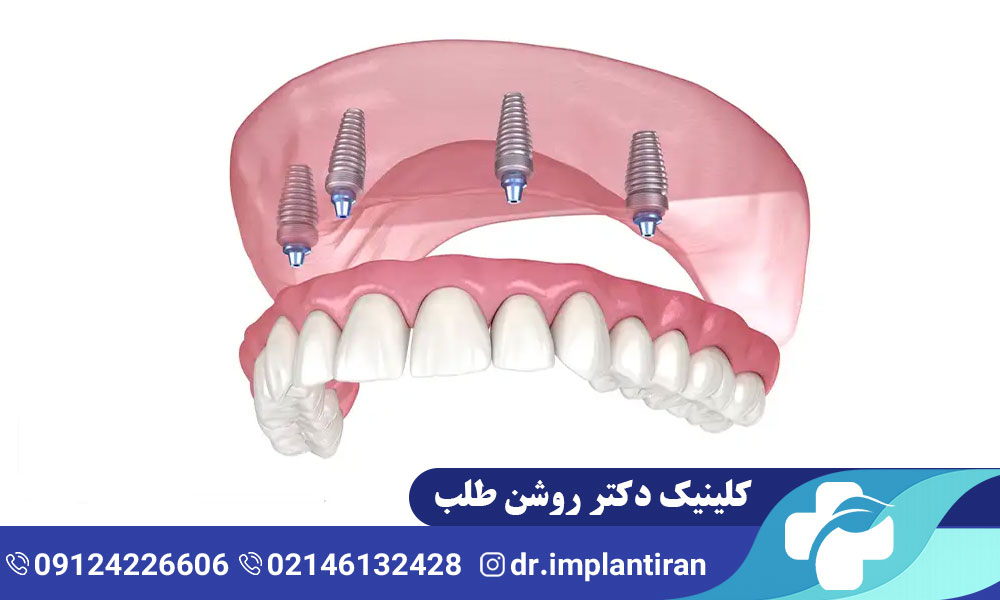 ایمپلنت متحرک