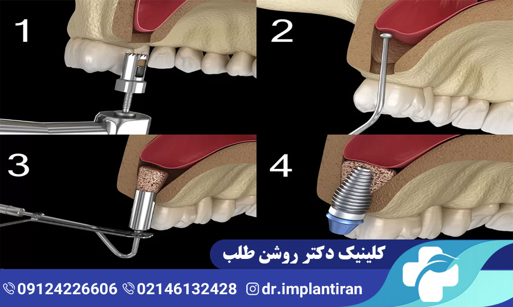 تفاوت عمل لیفت سینوس باز و بسته