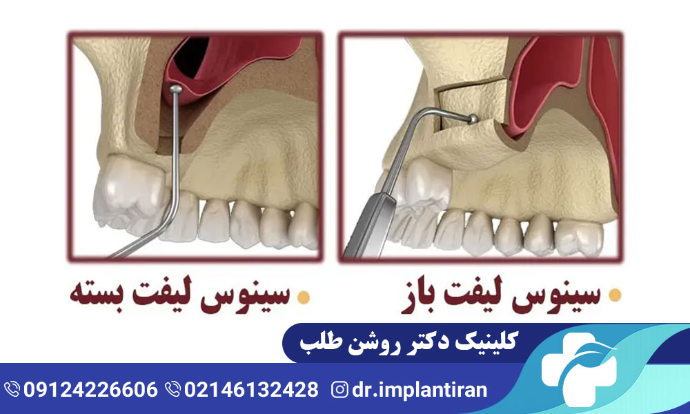 تفاوت عمل لیفت سینوس باز و بسته