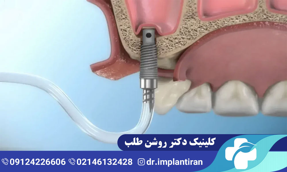 تفاوت عمل لیفت سینوس باز و بسته