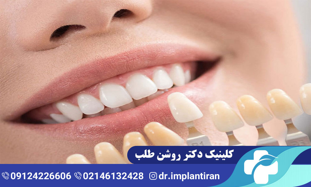 معرفی انواع لمینت دندان