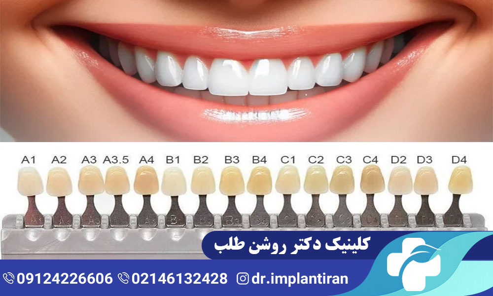 معرفی انواع لمینت دندان