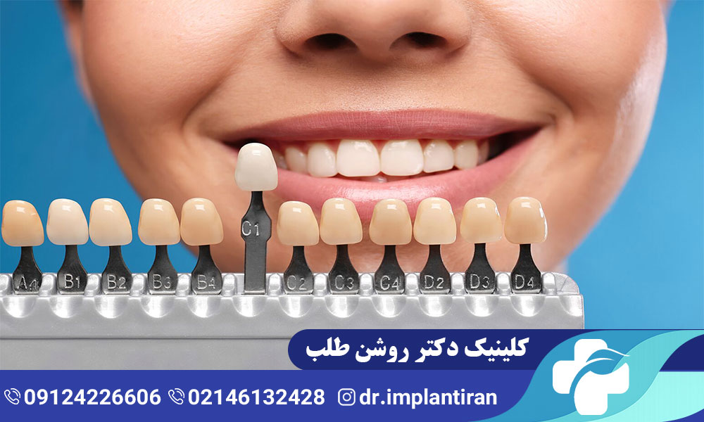 معرفی انواع لمینت دندان