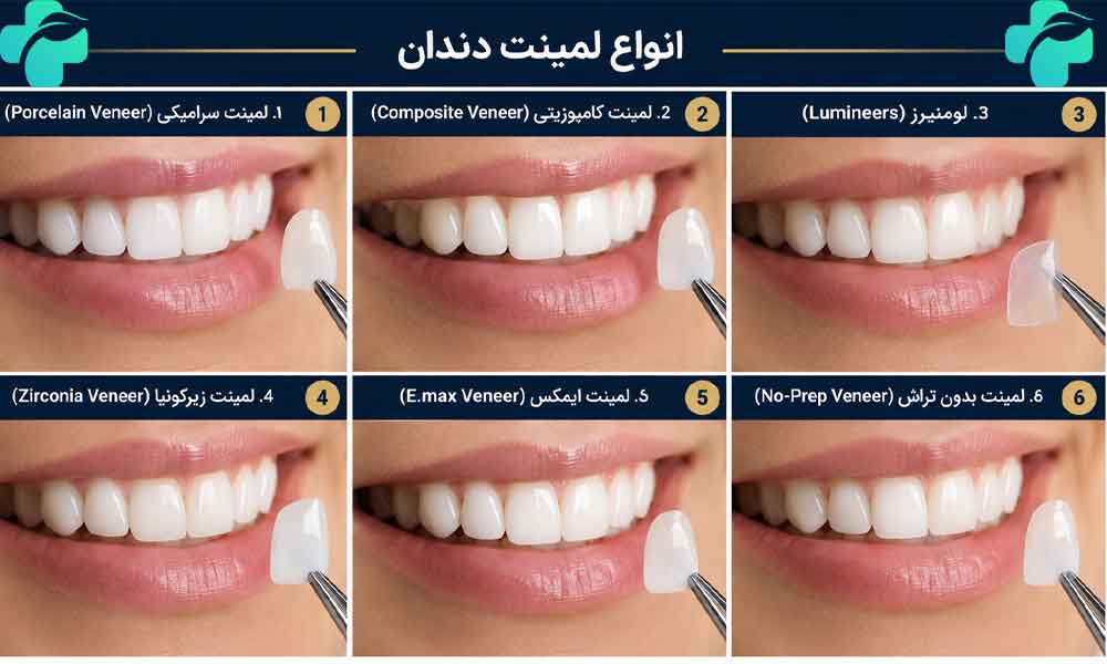 انواع لمینت دندان