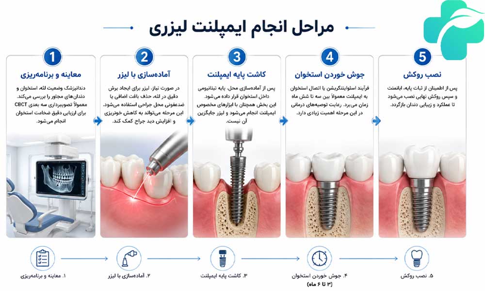 مراحل ایمپلنت لیزری