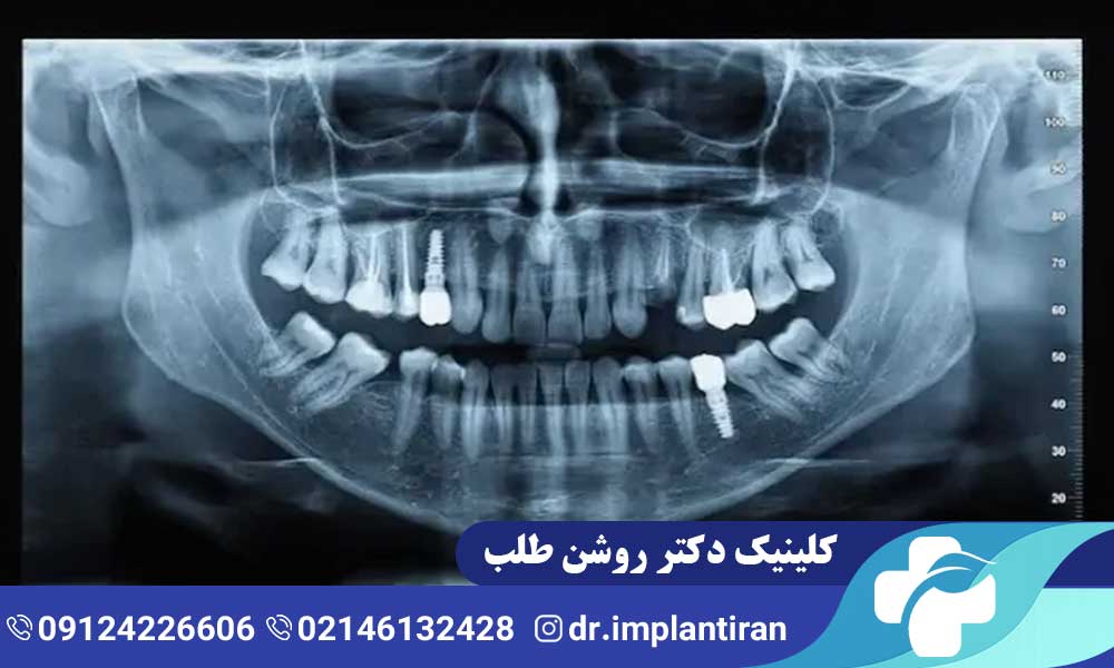 اسکن سه بعدی دندان برای ایمپلنت