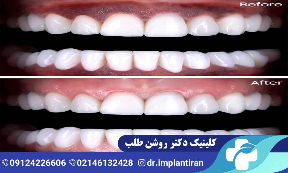 سیاهی لثه کودکان