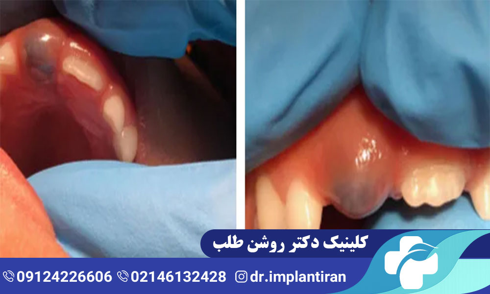 سیاهی لثه کودکان