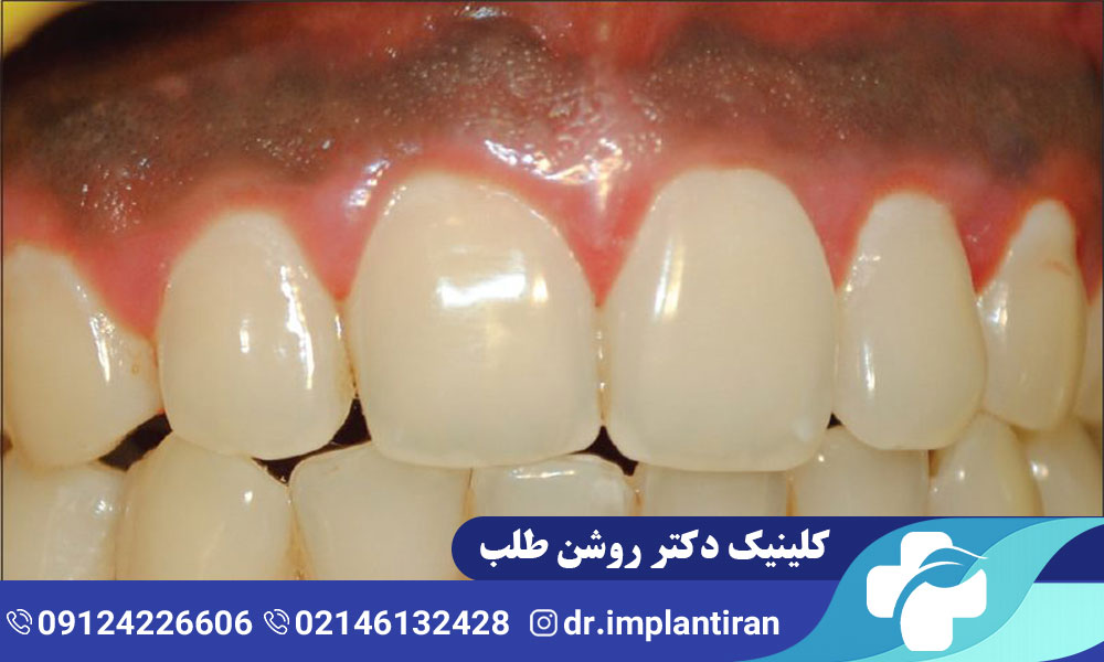 سیاهی لثه کودکان