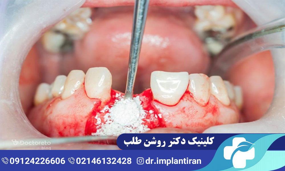 پیوند استخوان در ایمپلنت