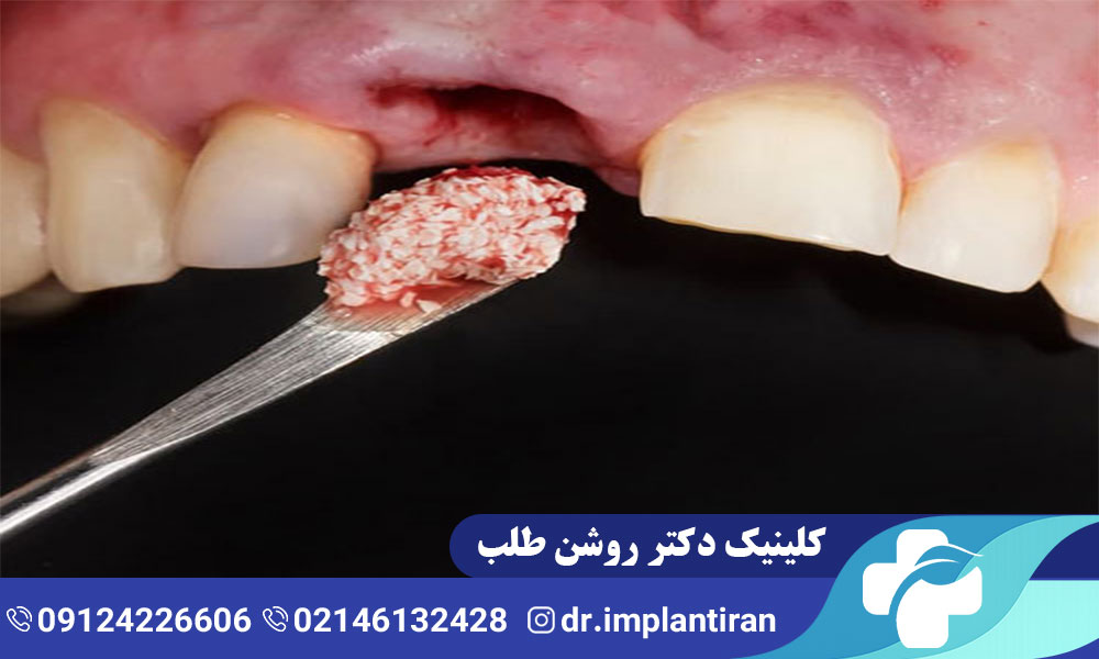 پیوند استخوان در ایمپلنت