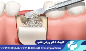 پیوند استخوان در ایمپلنت