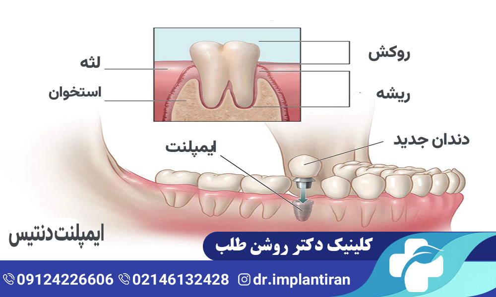 ایمپلنت دنتیس