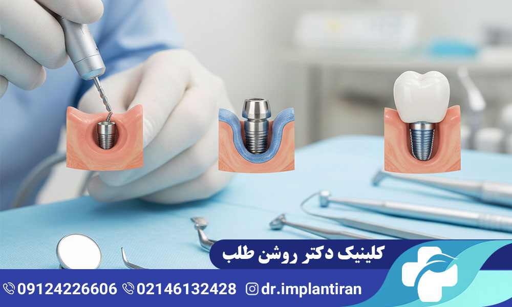 ایمپلنت دنتیس
