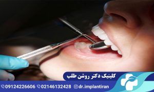 ایمپلنت دنتیس