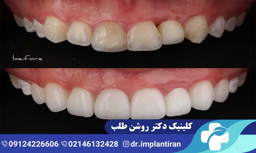 عمر لمینت دندان