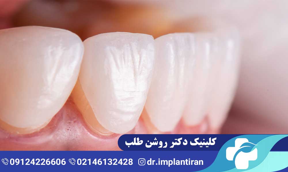 عمر لمینت دندان