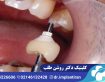 روکش ایمپلنت دندان چیست؟ مراحل، انواع و ماندگاری آن
