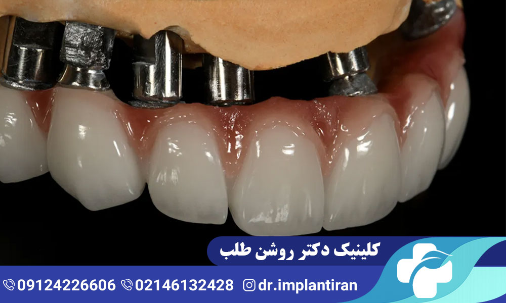 روکش ایمپلنت