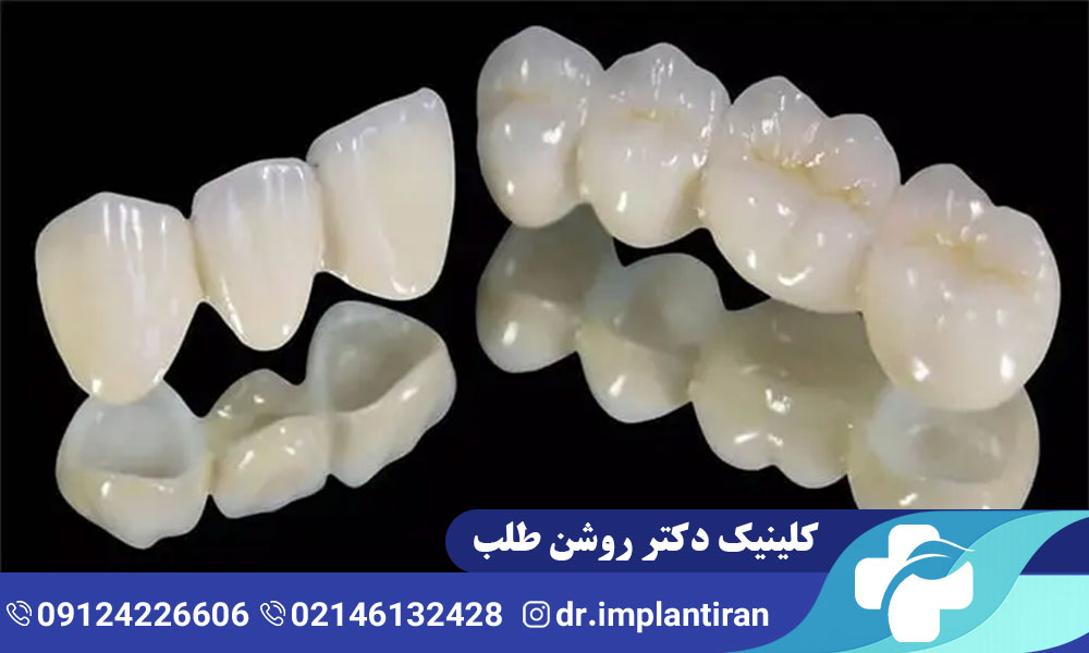 روکش ایمپلنت