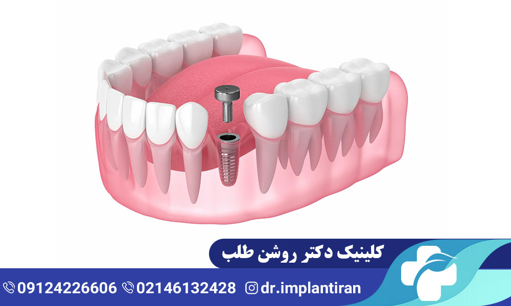 هیلینگ ایمپلنت