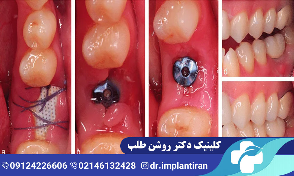 هیلینگ ایمپلنت